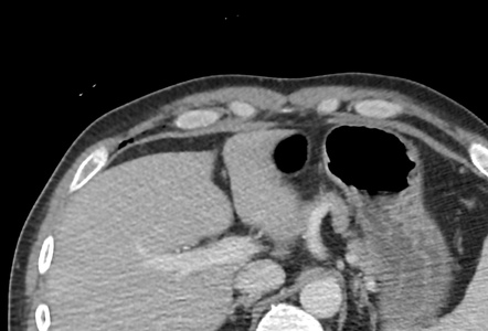 Benign post-traumatic pseudopneumoperitoneum | Radiology Reference ...