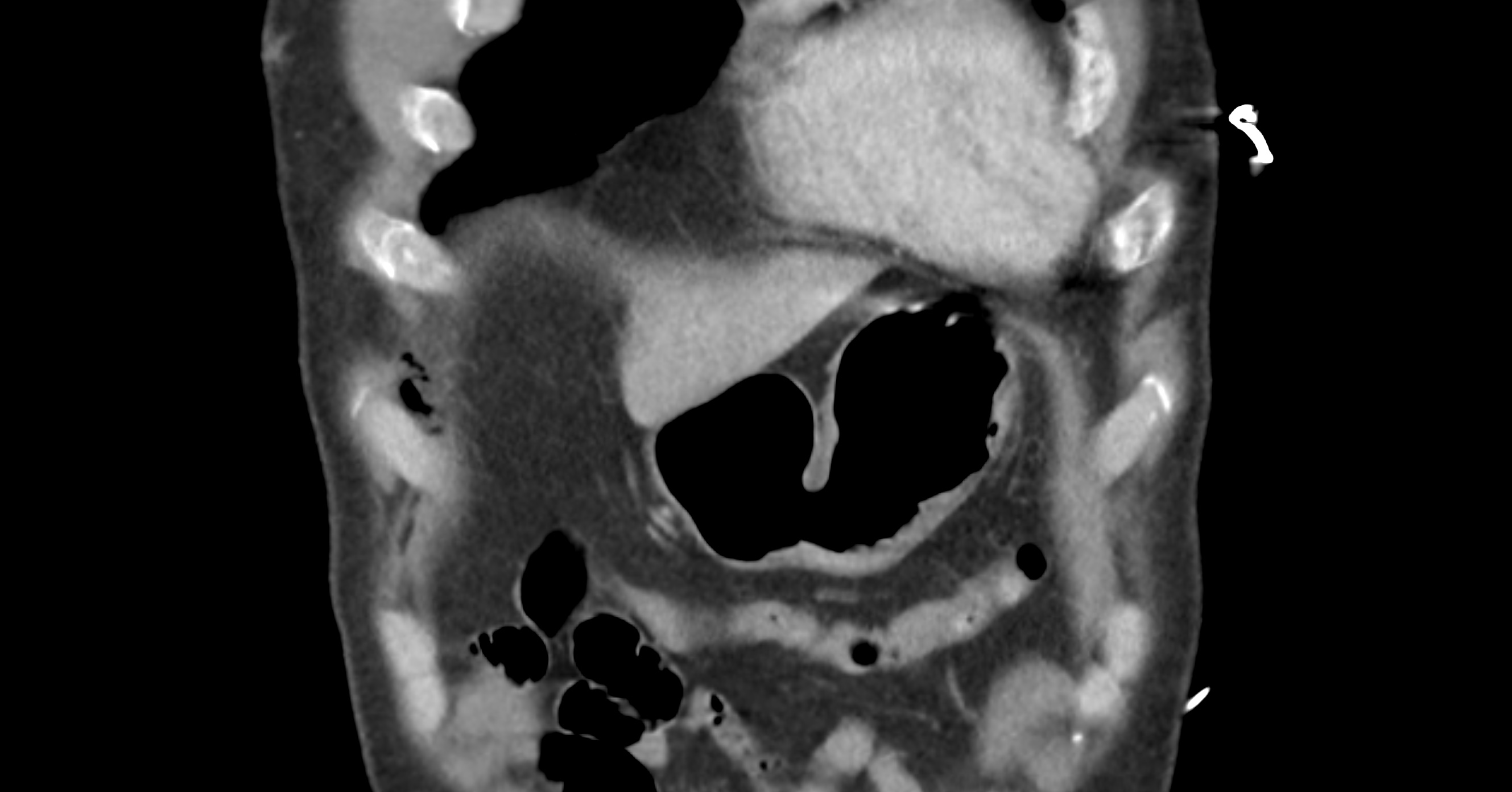 Benign post-traumatic pseudopneumoperitoneum | Image | Radiopaedia.org