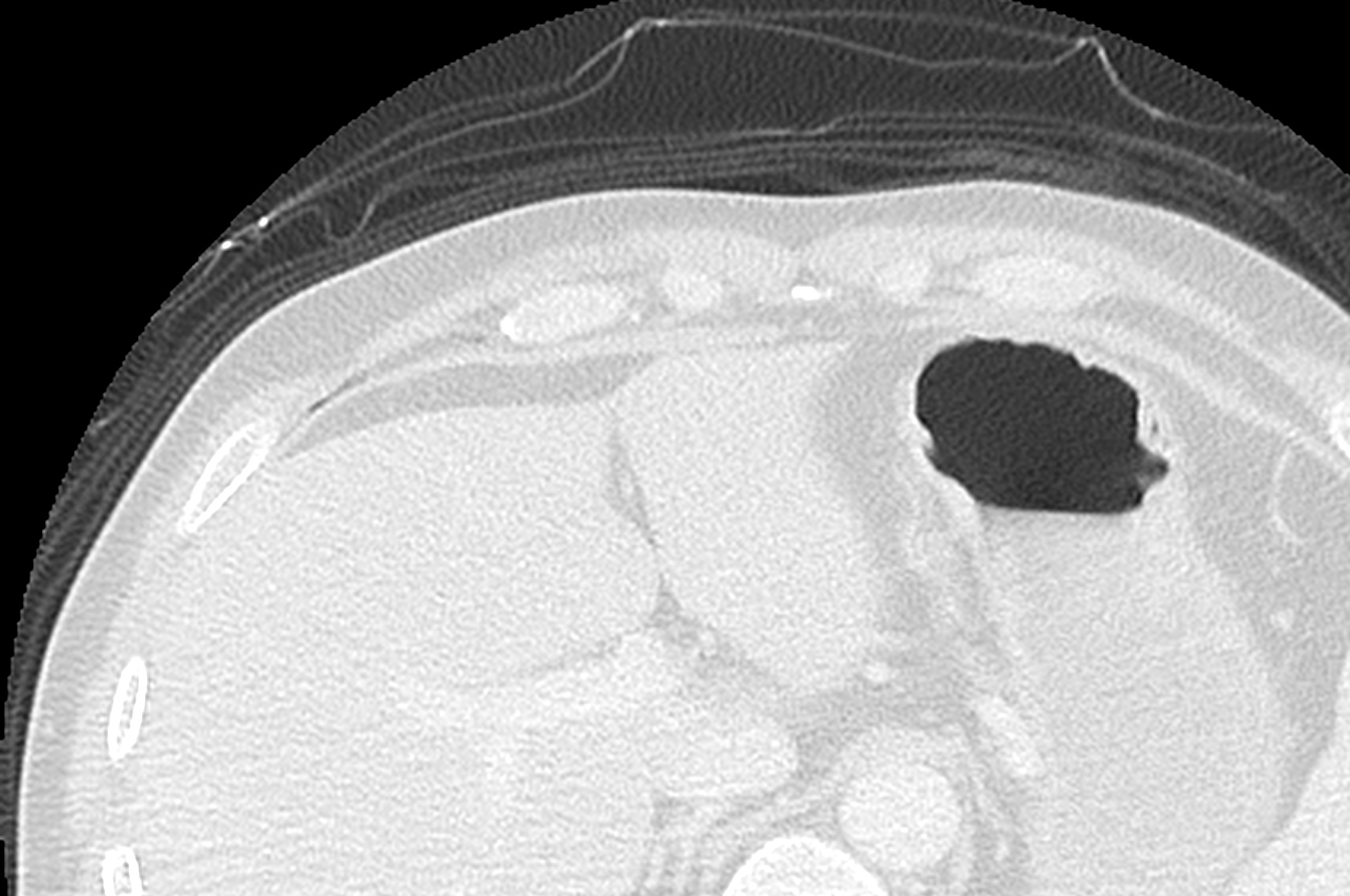 Benign post-traumatic pseudopneumoperitoneum | Image | Radiopaedia.org