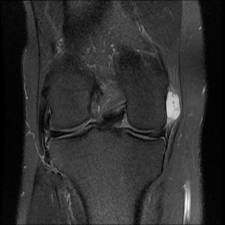 Medial collateral ligament ganglion cyst | Radiology Case | Radiopaedia.org