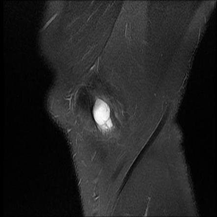 Medial collateral ligament ganglion cyst | Image | Radiopaedia.org