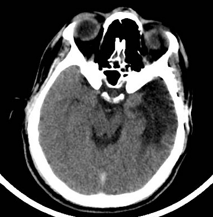 Transverse sinus thrombosis | Radiology Case | Radiopaedia.org