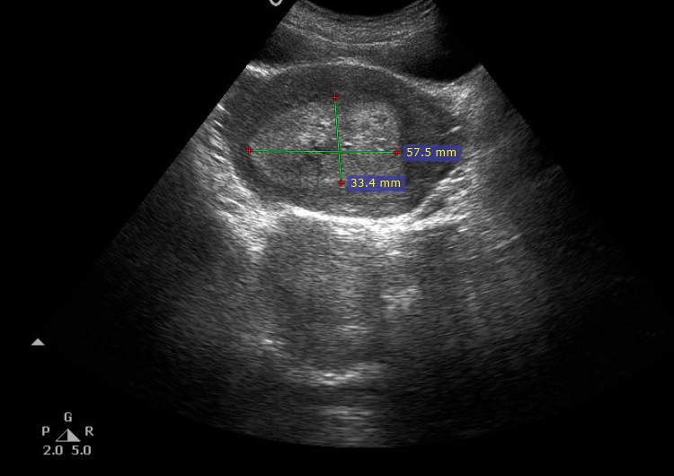 Retained products of conception | Image | Radiopaedia.org