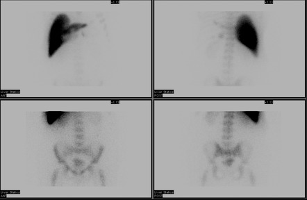 Tc-99m sulfur colloid | Radiology Reference Article | Radiopaedia.org