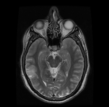 Dysembryoplastic neuroepithelial tumor | Image | Radiopaedia.org