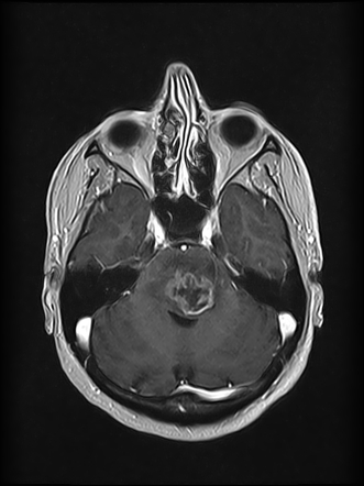 Brainstem glioma | Radiology Case | Radiopaedia.org