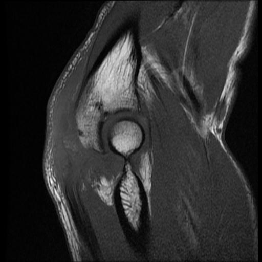 Triceps tendon tear | Image | Radiopaedia.org