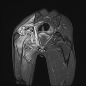 Septic arthritis | Radiology Reference Article | Radiopaedia.org