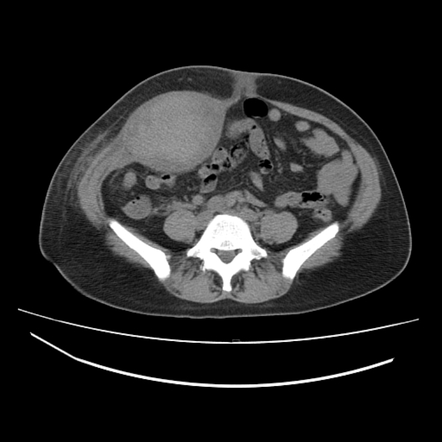 Rectus sheath hematoma | Radiology Reference Article | Radiopaedia.org