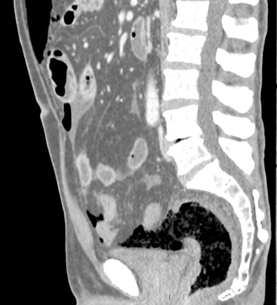 Rectum perforation by foreign body | Radiology Case | Radiopaedia.org