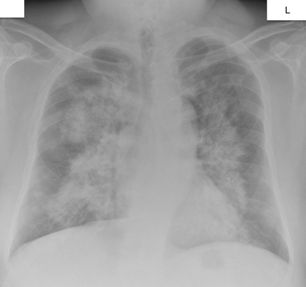 Pulmonary Alveolar Proteinosis Radiology