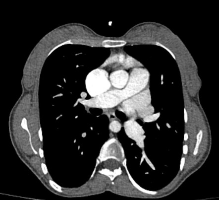 Total Anomalous Pulmonary Venous Return (TAPVR) - Supracardiac Type ...