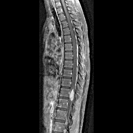 Spinal ependymoma | Radiology Reference Article | Radiopaedia.org