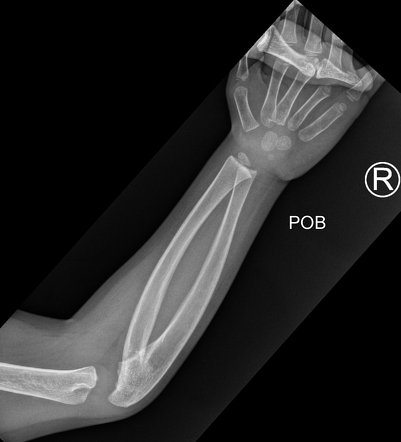 Bilateral proximal radio-ulnar synostosis | Radiology Case ...