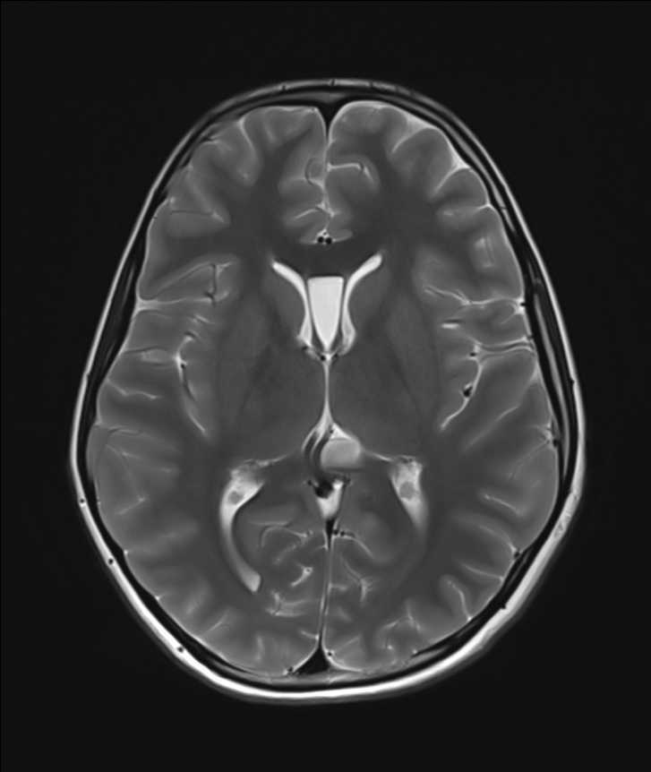 Pineal region epidermoid cyst | Image | Radiopaedia.org