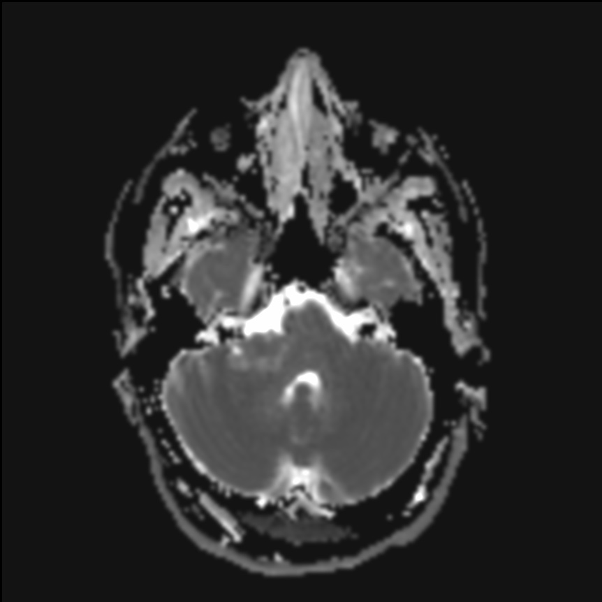 Cerebellopontine Angle Epidermoid Image 2756