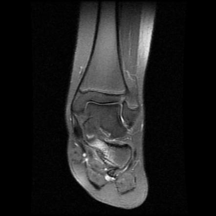 Calcaneonavicular Coalition Radiology Case Radiopaedia Org