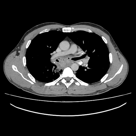 Silicotuberculosis | Image | Radiopaedia.org