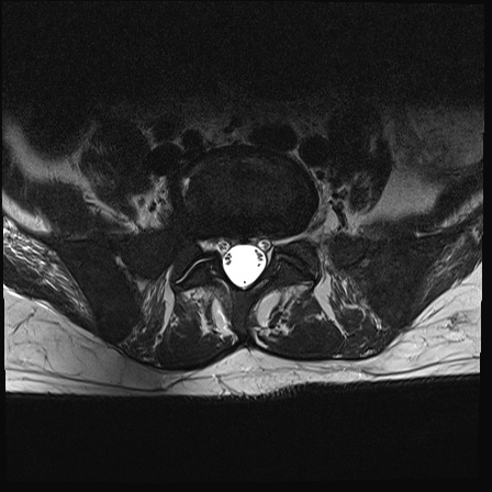 Bing-Neel syndrome | Image | Radiopaedia.org