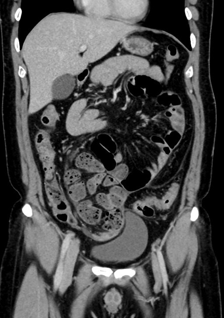 Abdominal cocoon Radiology Case Radiopaedia