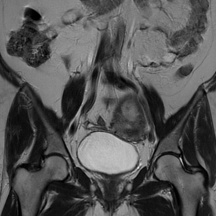 Uterine lipoleiomyoma | Image | Radiopaedia.org