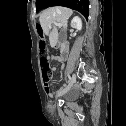 De Garengeot hernia | Image | Radiopaedia.org