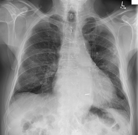 Coronary artery bypass graft | Radiology Reference Article ...