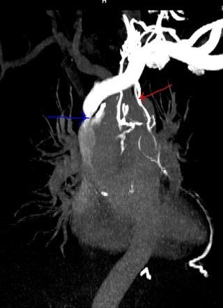 Esophageal varix | Radiology Reference Article | Radiopaedia.org