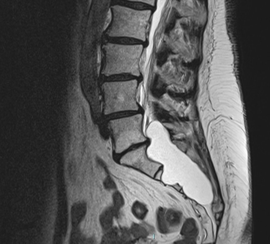 Tarlov Cyst Anatomy