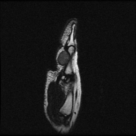 Tenosynovial giant cell tumor - thumb | Radiology Case | Radiopaedia.org