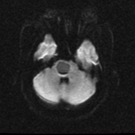 Neuroglial cyst - brainstem | Image | Radiopaedia.org