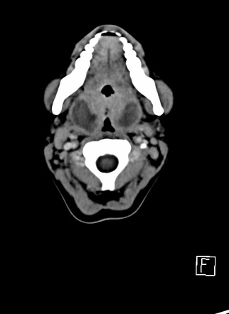 Bilateral peritonsillar abscesses | Radiology Case | Radiopaedia.org