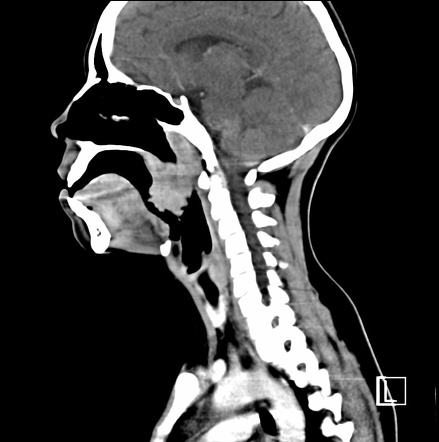 Bilateral peritonsillar abscesses | Image | Radiopaedia.org