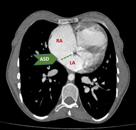 Total anomalous pulmonary venous return (TAPVR) - supracardiac type ...