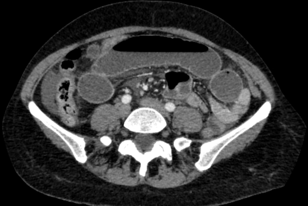 Closed loop small bowel obstruction Radiology Case Radiopaedia