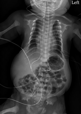 Asphyxiating thoracic dystrophy | Image | Radiopaedia.org