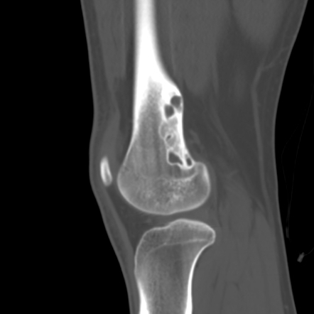 Non-ossifying fibroma - femur | Radiology Case | Radiopaedia.org