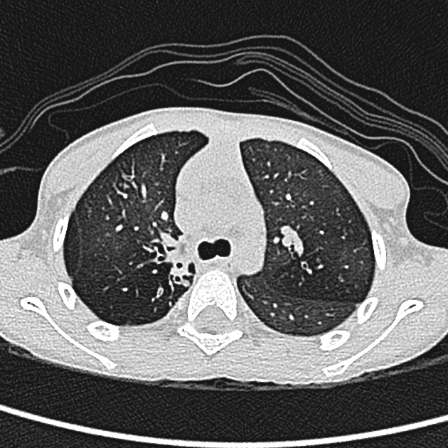 Bronchiectasis - CXR and CT - Radiology at St. Vincent's University Hospital