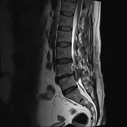 Sequestered disc | Image | Radiopaedia.org