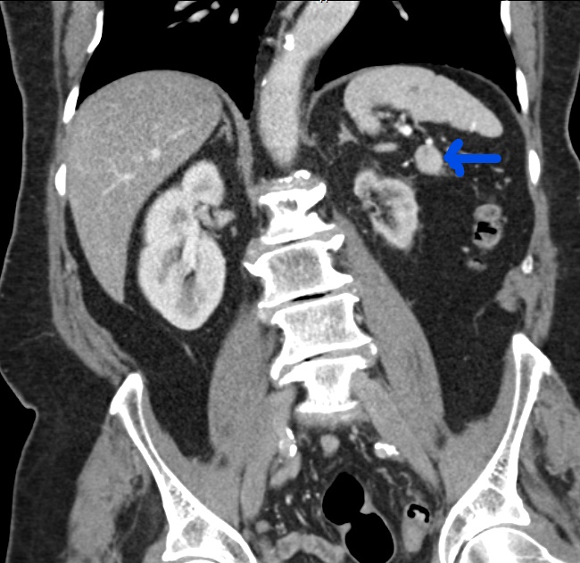 Splenule | Image | Radiopaedia.org