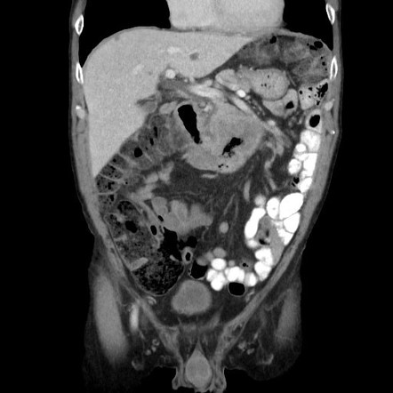 Primary squamous cell carcinoma of the duodenum | Radiology Case ...