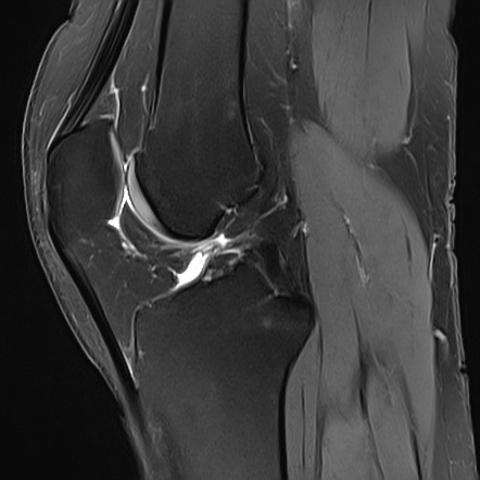 Bucket handle tear - lateral meniscus | Radiology Case | Radiopaedia.org