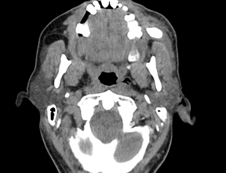 Sialolithiasis - parotid | Radiology Case | Radiopaedia.org