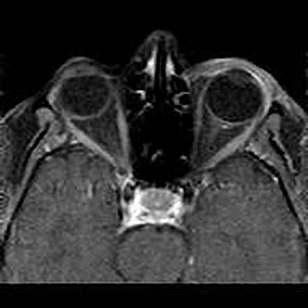 Orbital Metastasis Of Multiple Myeloma | Image | Radiopaedia.org