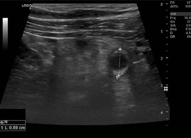 Featured image of post Radiopaedia Appendix Appendices is a blind muscular tube that arises from the advertisement