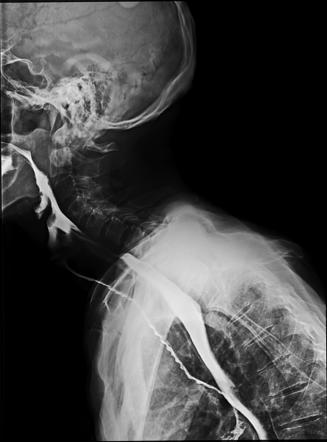 Barium Swallow Aspiration | Image | Radiopaedia.org