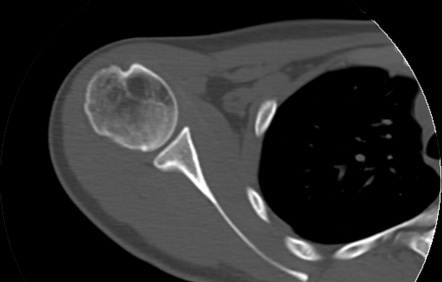 Osteochondroma - humerus | Image | Radiopaedia.org