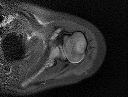 Glenoid hypoplasia | Radiology Reference Article | Radiopaedia.org