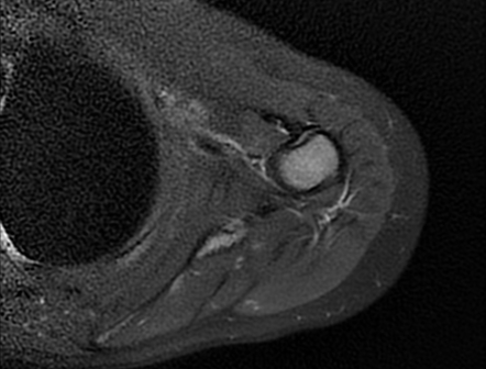 Glenohumeral dysplasia secondary to brachial plexus birth palsy | Image ...