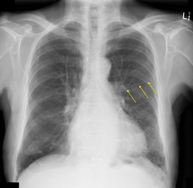 Intercostal catheter | Radiology Reference Article | Radiopaedia.org